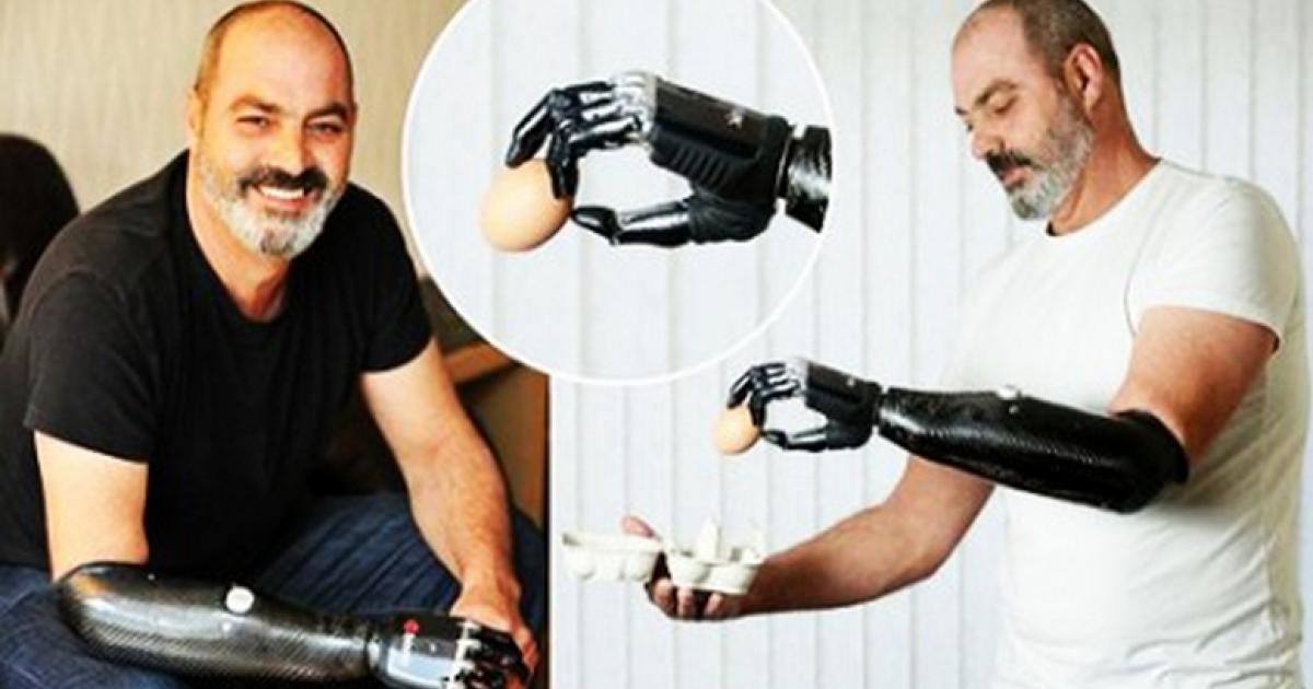Самый дорогой протез. Найджел Экланд бионическая рука. Bebionic протезы. Bebionic 3 протез. Touch Bionics протезы.