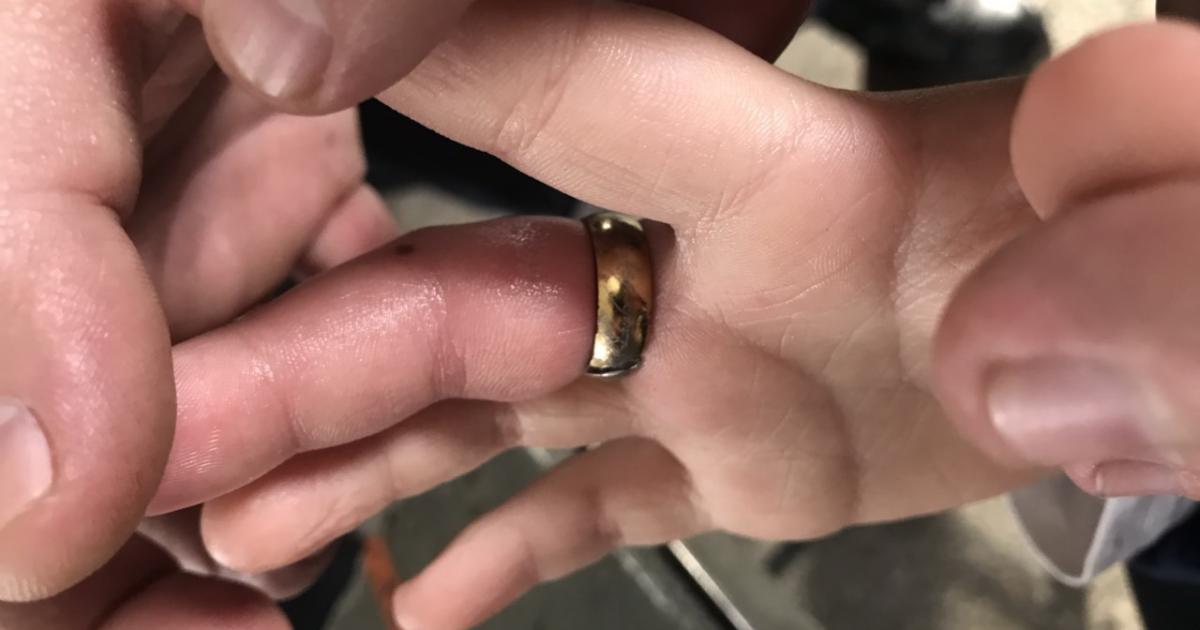 снимаю кожу с пальцев